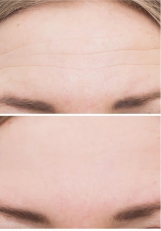 Before-and-after forehead comparison showing smoother-looking skin after treatment.