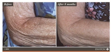 Before-and-after forearm skin comparison after starting the Environ Body EssentiA set.