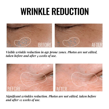 Before-and-after eye and lip area images showing visible line reduction after 4 and 12 weeks.