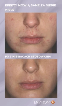Before-and-after close-up of facial skin after three months of using the Environ Clarity line.