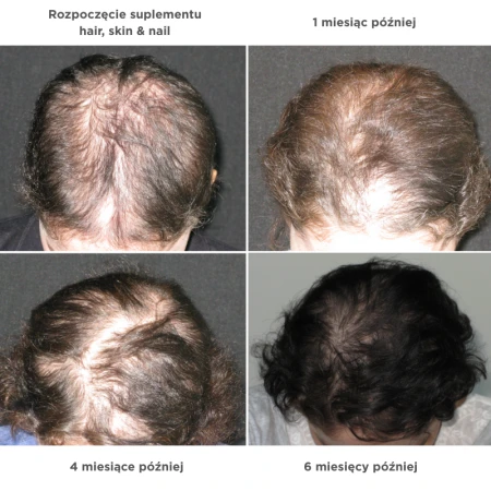 Progress image showing hair appearance at the start and after 1, 4 and 6 months of Hair, Skin, Nails supplementation.