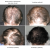 Progress image showing hair appearance at the start and after 1, 4 and 6 months of Hair, Skin, Nails supplementation.