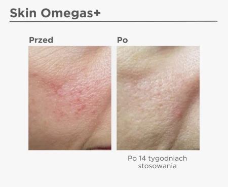 Before and after skin comparison after 14 weeks of Skin Omegas+ supplementation.