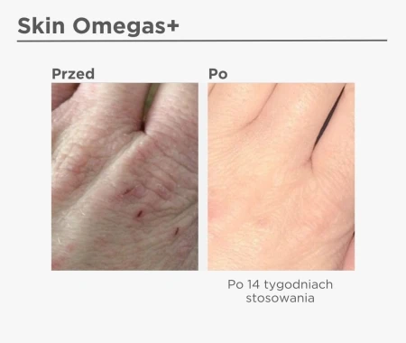 Hand skin comparison before and after 14 weeks of Skin Omegas+ supplementation.